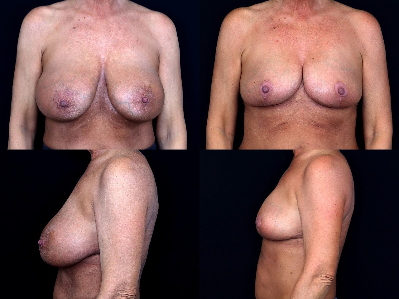 Breast Explant 3